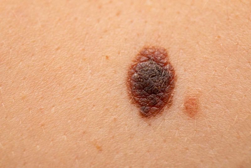 east-toowoomba-skin-cancer-clinic_2